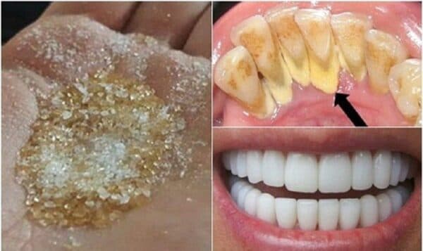 Làm sạch cao răng tại nhà tiết kiệm nhưng cần thời gian lâu dài