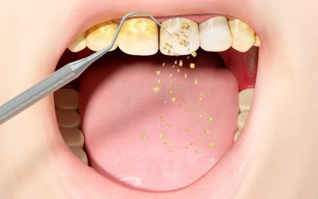 Làm sao hết cao răng và cách ngăn ngừa cao răng