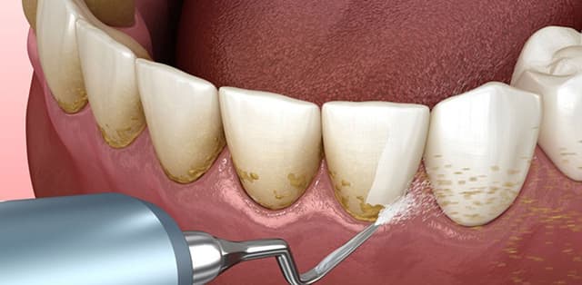 Giải đáp thắc mắc lấy cao răng bao tiền