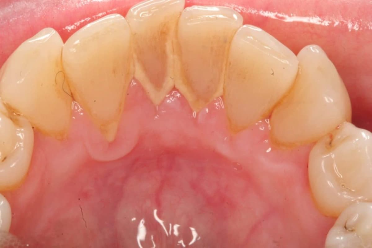 Dành cho những ai thắc mắc lấy cao răng có đắt không
