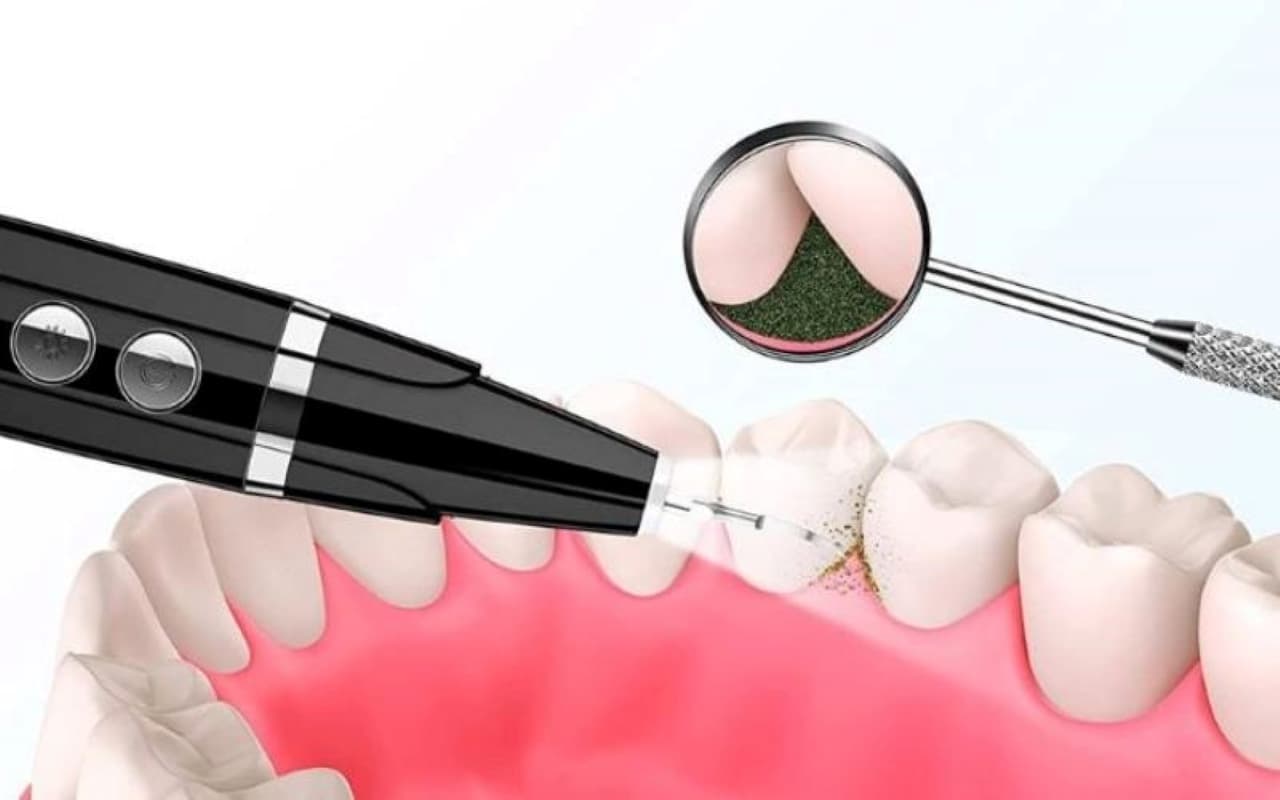 lấy cao răng uy tín