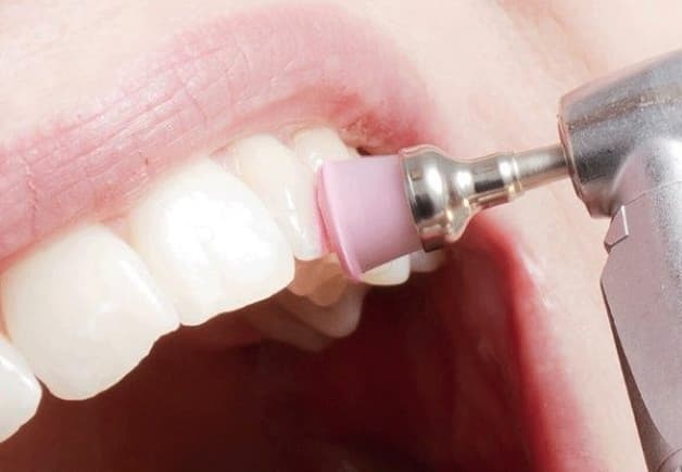 Phương pháp cạo vôi dưới nướu