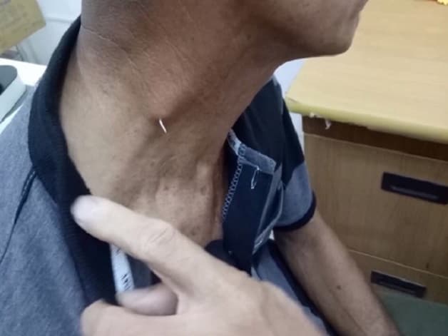 Hậu quả của lấy xương cá khi bị hóc quá trễ và sai cách