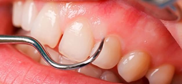 Cạo vôi răng truyền thống