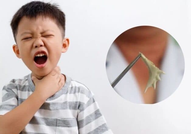 phát hiện mắc xương cá lâu ngày