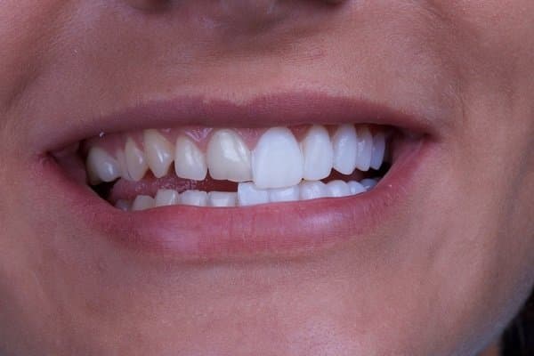 Có nên chọn mặt dán sứ veneer để phục hình răng?