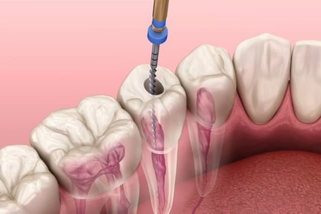 Những thông tin về chữa tủy bằng máy điều trị tủy răng