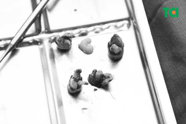 Mỗi người chỉ có tối đa 4 răng khôn, không thể mọc 5 răng khôn 