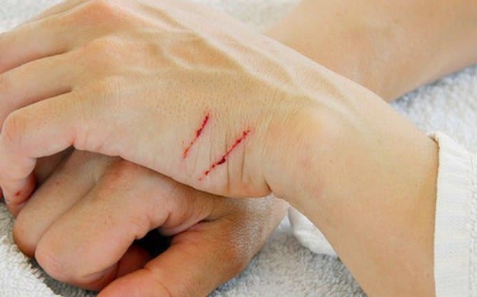 Các vết thương nhẹ hơn như trầy xước da, bị bỏng,... thì vẫn cần tiêm ngừa uốn ván để đảm bảo an toàn