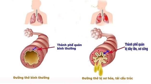 Nguyên nhân gây viêm phế quản khó thở