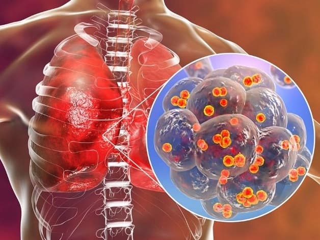 Nguyên nhân gây bệnh viêm phổi ở người lớn