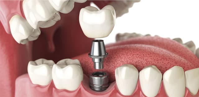 Tìm hiểu dịch vụ nha khoa cấy ghép Implant