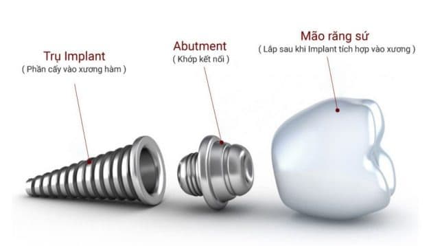 nha khoa cấy ghép Implant như thế nào