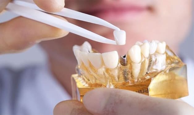 nha khoa cấy ghép Implant