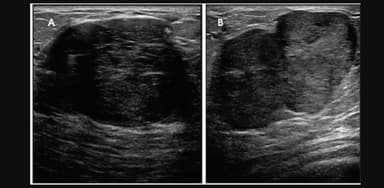 Nhân giảm âm tuyến vú 2 bên có nguy hiểm không?
