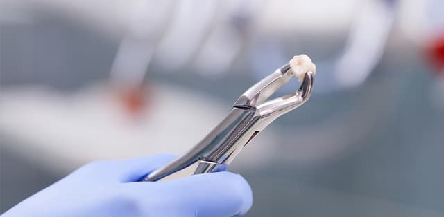 Giải đáp thắc mắc nhổ răng khôn ở đâu Hà Nội