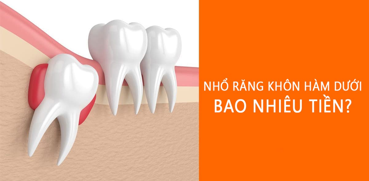 Tìm hiểu chi phí nhổ răng khôn hàm dưới bao nhiêu tiền