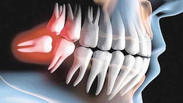 nhổ răng khôn mọc lệch