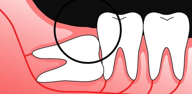 Việc không thể tránh: nhổ răng khôn mọc lệch 90 độ