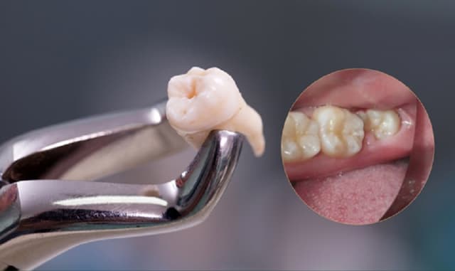 Những tiêu chí cho một địa chỉ nhổ răng khôn uy tín