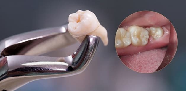 khi nhổ răng không, câu hỏi mà mọi người đều hỏi là: nhổ răng số 8 bao nhiêu tiền