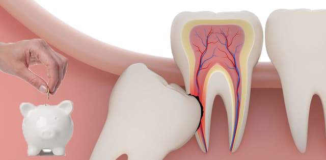 Giải đáp thắc mắc nhổ răng số 8 bao nhiêu tiền