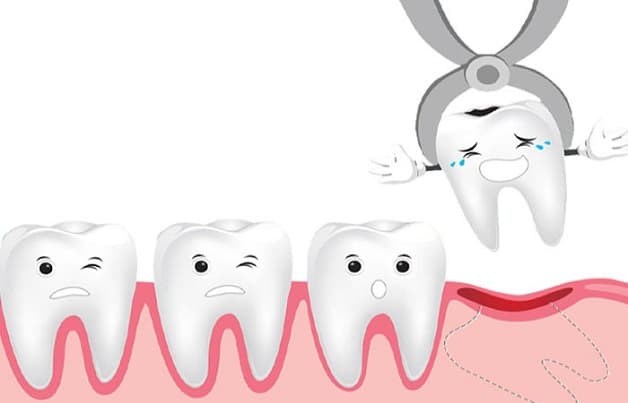 Thông tin về Nhổ răng số 8 giá bao nhiêu