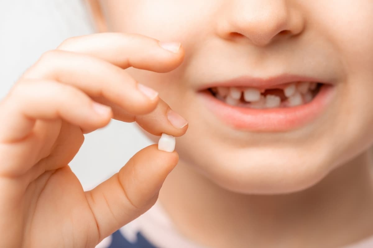 Những việc cha mẹ cần làm khi nhổ răng sữa còn chân
