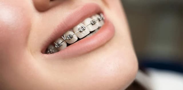 Kinh nghiệm khi niềng răng Hà Nội