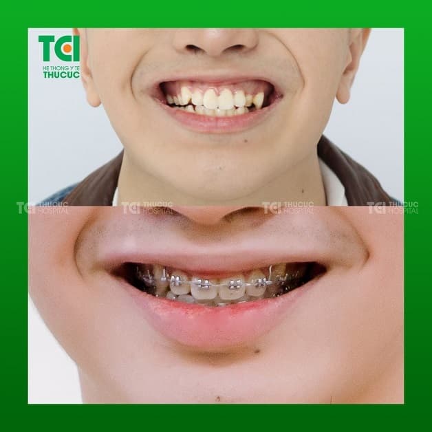 kết quả Niềng răng Hà Nội