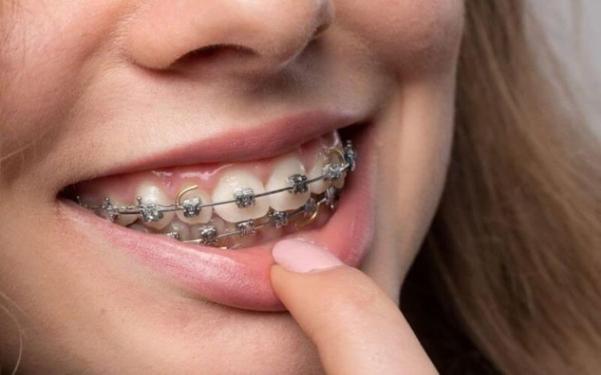 Lời khuyên dành cho ai đang muốn niềng răng giá rẻ