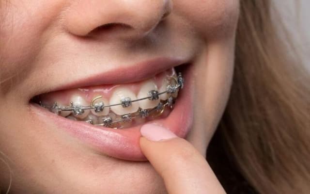 Lời khuyên dành cho ai đang muốn niềng răng giá rẻ