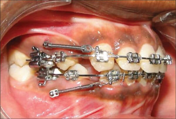 niềng răng giá rẻ