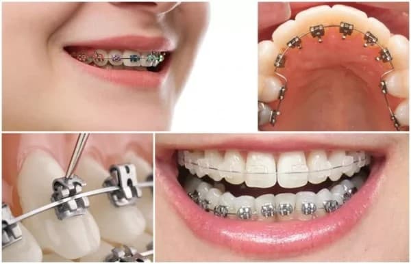 niềng răng giá rẻ ở Hà Nội
