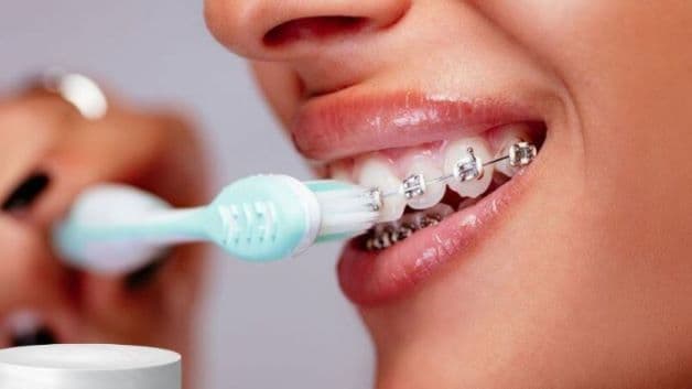Chải răng đúng cách sẽ giúp bảo vệ tốt cho sức khỏe hàm răng đang niềng