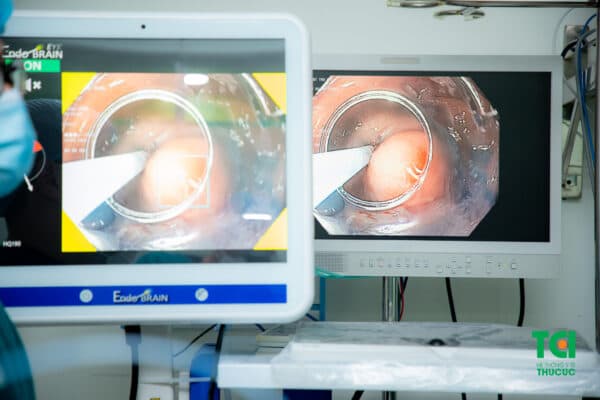 Ưu điểm của nội soi gây mê