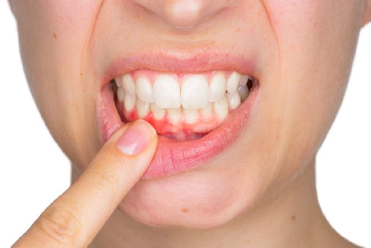 Nướu răng yếu do viêm và cách phòng tránh