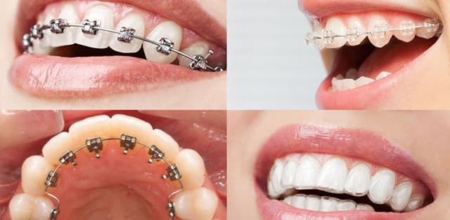 Tìm hiểu chi phí niềng răng của một số phương pháp cơ bản