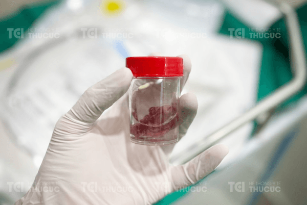 Polyp trực tràng sau cắt