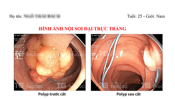 Polyp đại trực tràng lớn