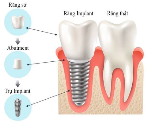 Tìm hiểu những thông tin về quá trình cấy ghép Implant