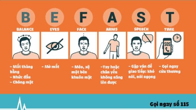 Quy tắc BEFAST trong sơ cứu tại chỗ cho người đột quỵ
