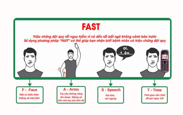 Nguyên tắc fast sơ cứu tại chỗ cho người bệnh đột quỵ