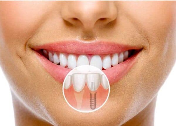 Trồng răng Implant là phương pháp gì?