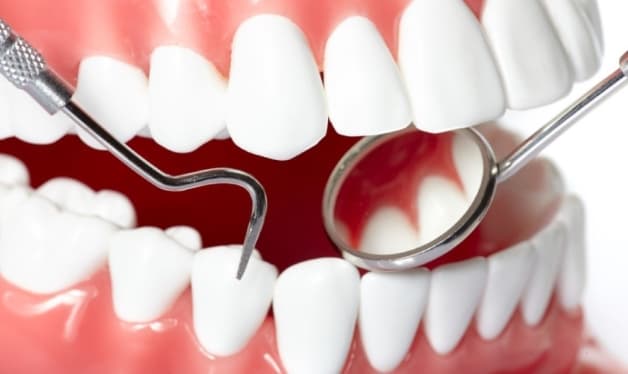 Điều trị răng bị vôi bám nhiều