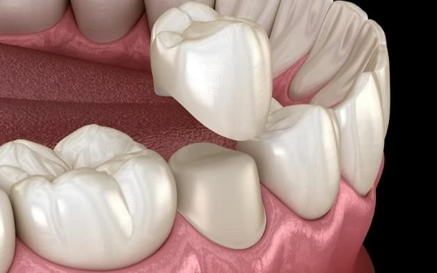 răng cấm bị sâu nặng