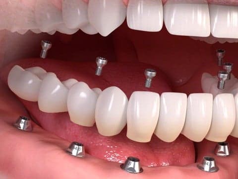 Răng cấy ghép implant là răng giả được tạo từ titanium