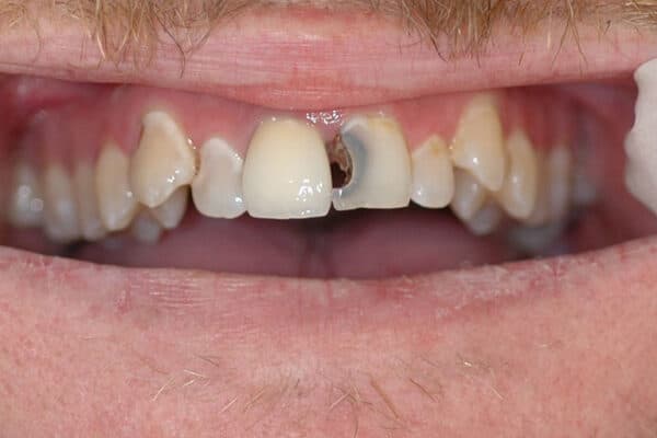 răng cửa bị sâu