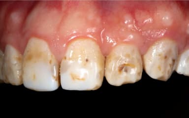 Nguyên nhân và cách chữa răng cửa bị sâu nặng