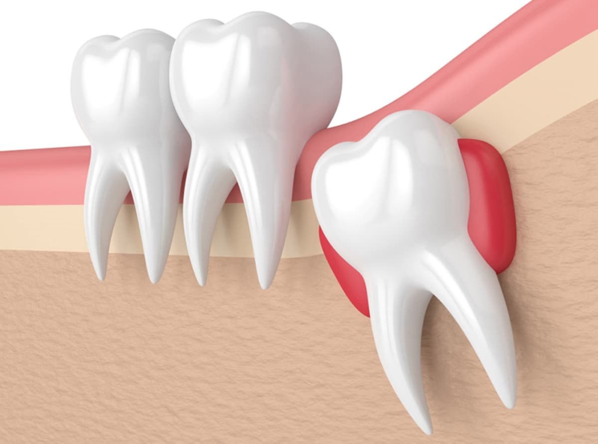 Phương pháp giúp nắn chỉnh răng mọc ngầm